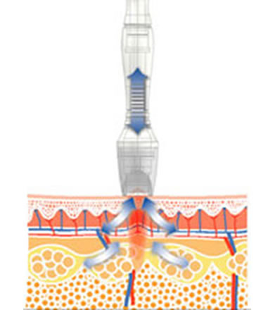 Lipolysis Handle With Mono-Polar Radio Frequency